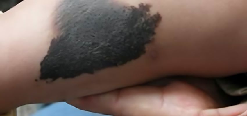 chiclayo aumenta en 5 el indice de casos de cancer a la piel