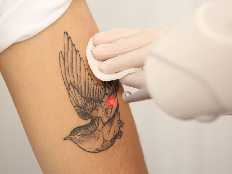 eliminacion de tatuajes con laser