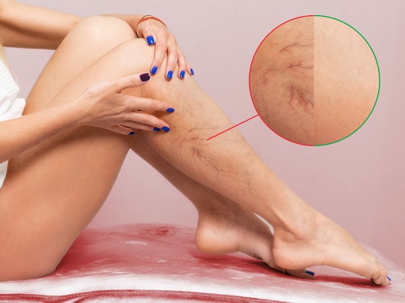 tratamiento vascular