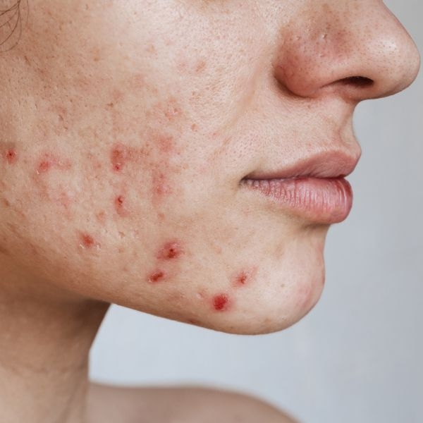 acne