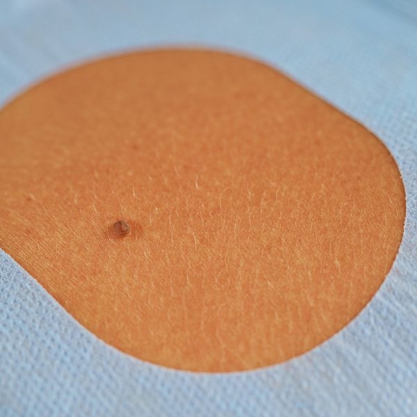 cirugia dermatologica