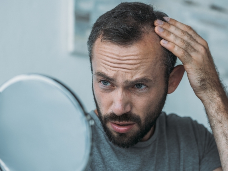 alopecia