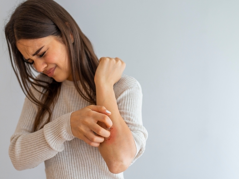 dermatitis atopica