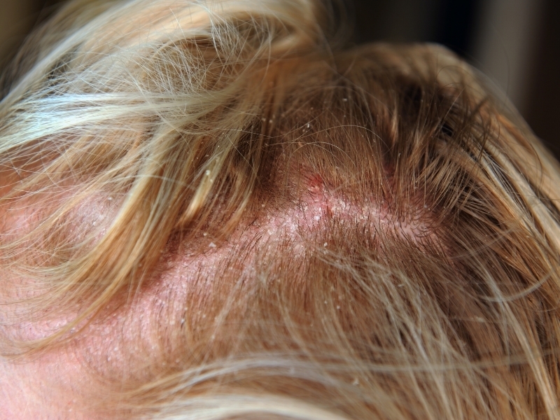dermatitis seborreica