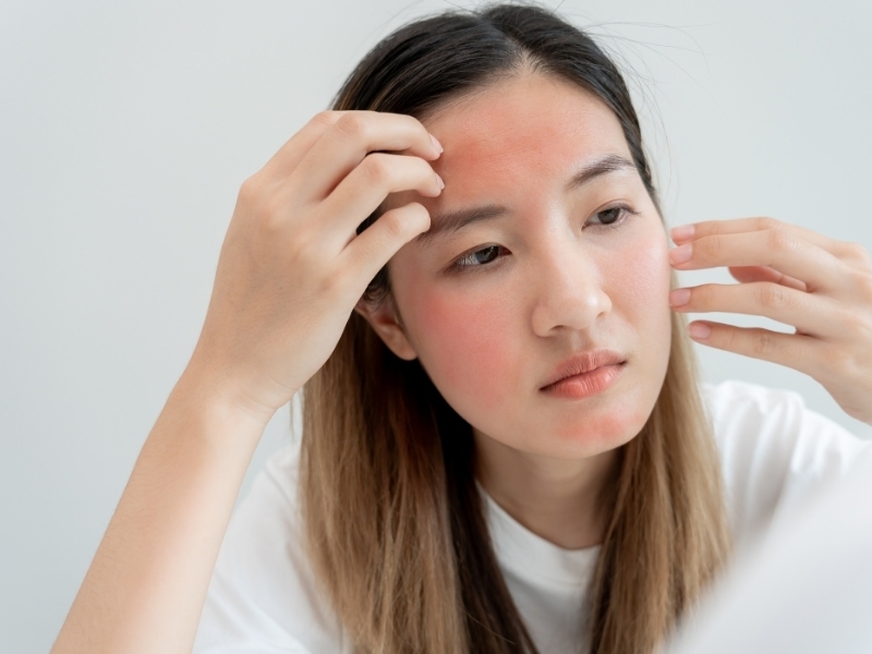 dermatitis