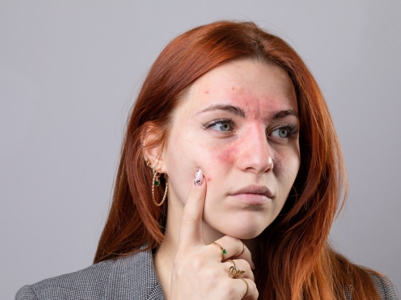 rosacea