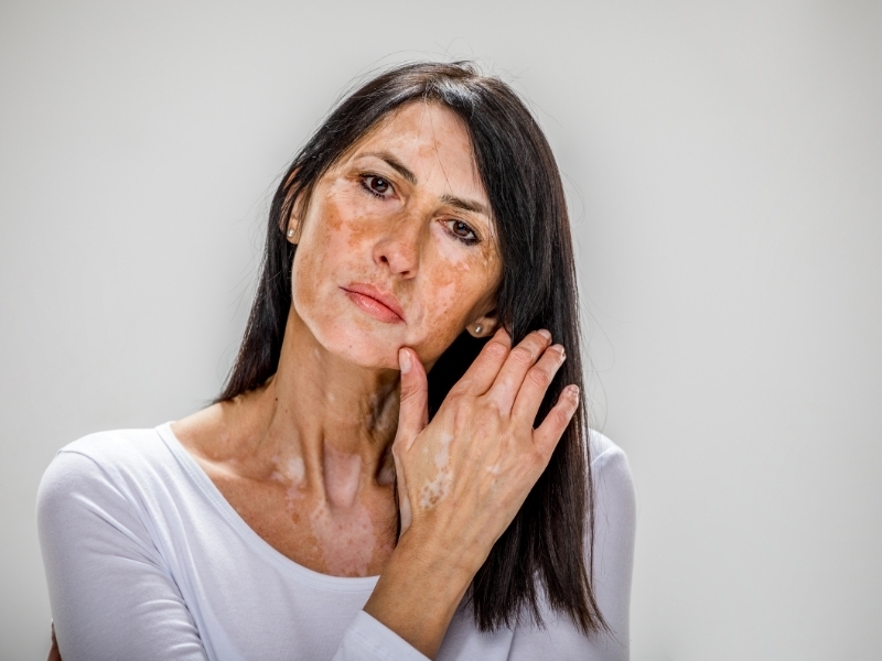 vitiligo